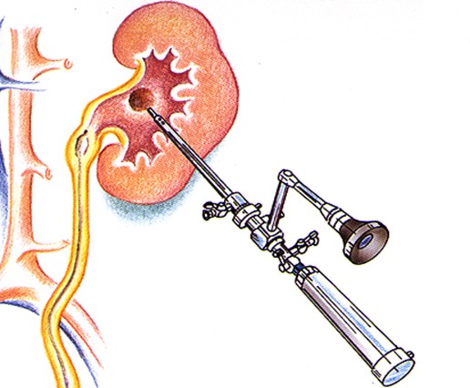 nephrolithotomie