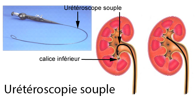 ureteroscopie
