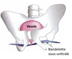 bandelette pour femme