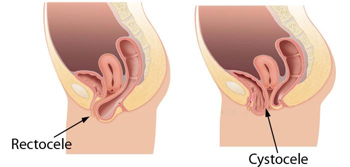rectocele cytocele