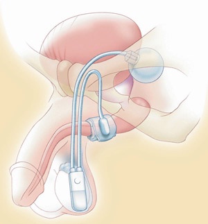 sphincter artificiel dessin