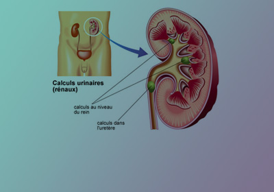 CALCULS URINAIRES