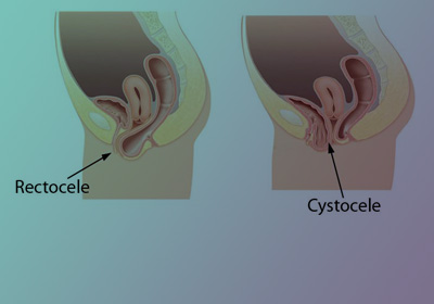 DESCENTE D'ORGANES